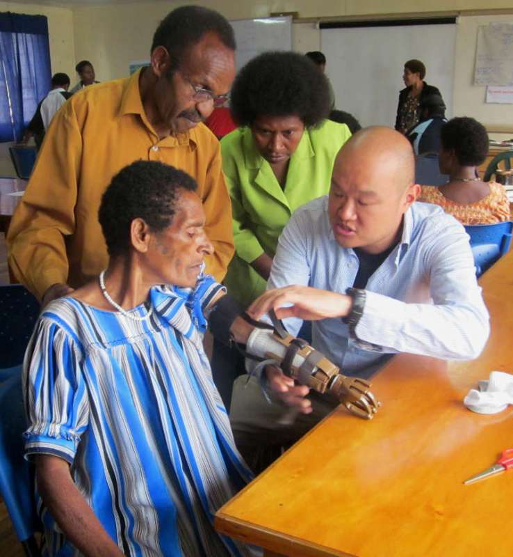 Patients with no arms now fitted with prosthetic hands